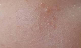 脸上长小疙瘩怎么办